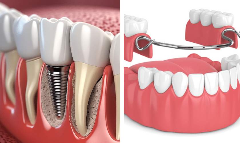 Front Teeth Dentures In Chennai