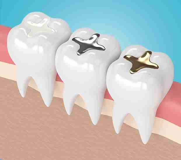 Composite Tooth Filling Near Villivakkam, Mogappair, Chennai