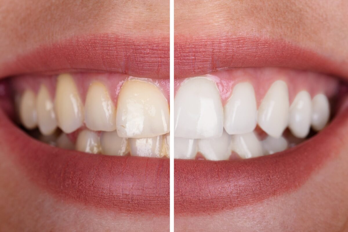 Permanent Teeth Whitening in Villivakkam, Chennai, Mogappair