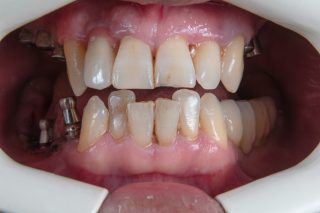 Pedo Zirconia Crowns