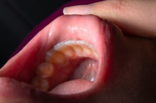 Oral Cancer Treatment