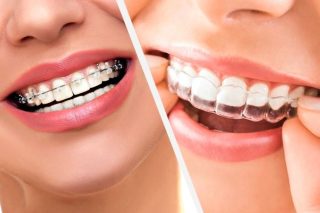 Choosing Between Invisible and Traditional Braces: What You Should Know