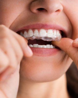 Benefits of Choosing Invisible Braces for Comfortable Teeth Alignment