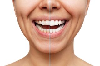 Cosmetic Smile Correction Treatment for a Perfect Smile