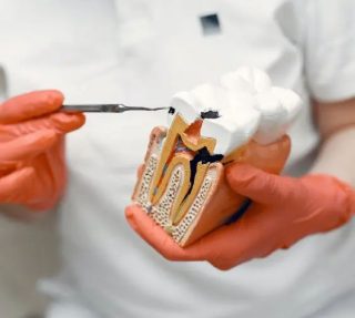 Things to Consider When Choosing a Root Canal Treatment Specialist